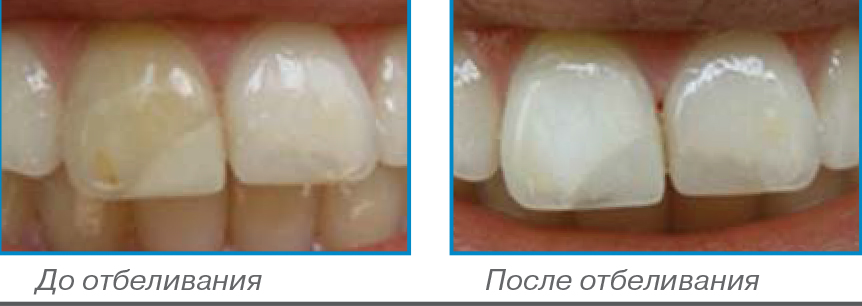  Opalescence Endo -  3